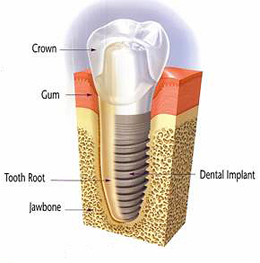Implants at Drummoyne Dental Practice