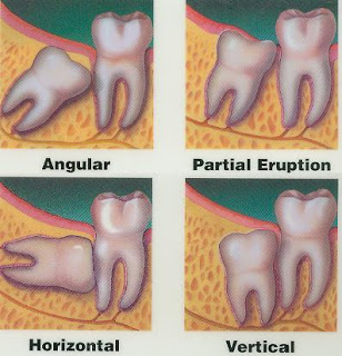 Wisdom teeth at Drummoyne Dental Practice