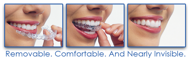 Invisalign: Invisible Teeth Straightening